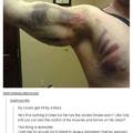 Bruised Tattoo may be 