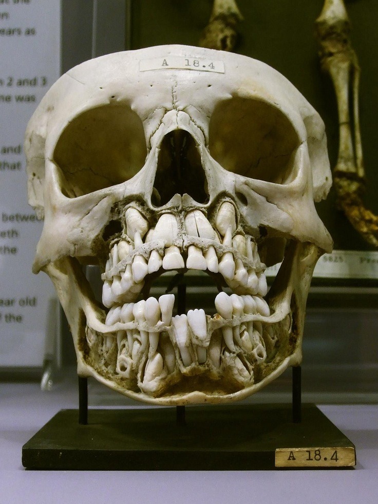 A childs skull with two rows of teeth, O_O - meme